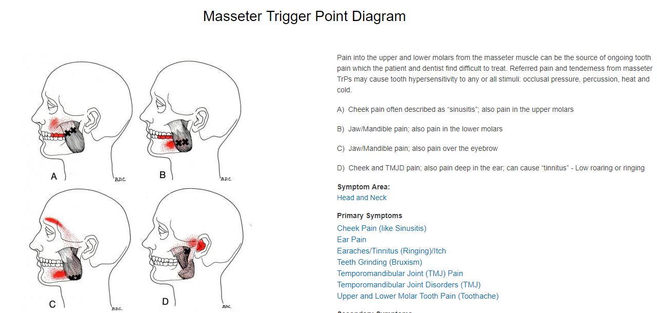 masseter trigger points