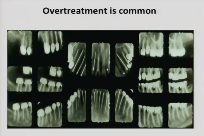 overtreatment is common root canals overtreatment is common root canals
