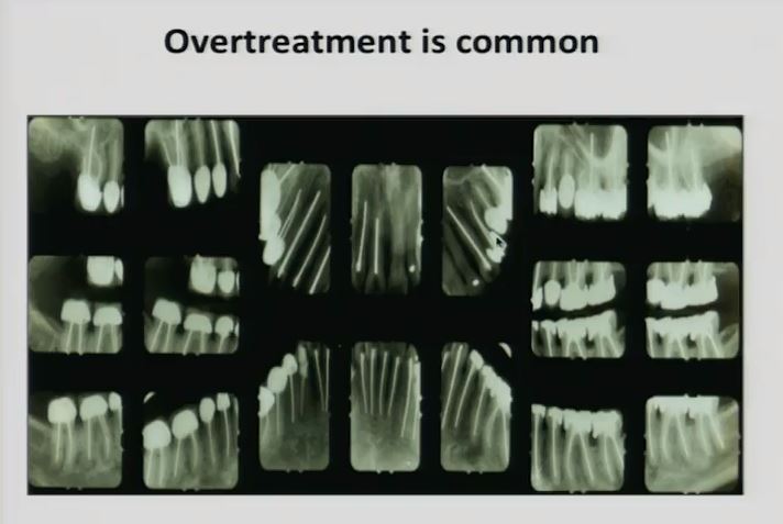 overtreatment is common root canals