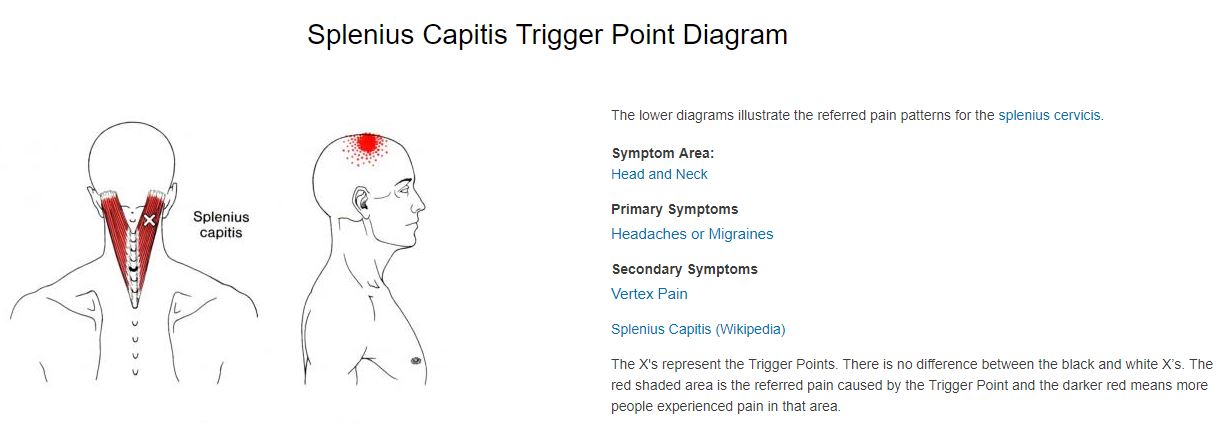 splenius capitis trigger point referral